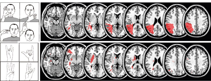 Abbildung: adaptiert von Goldenberg und Randerath, Neuropsychologia 2015 Abbildung: Während Finger- und Fußstellungen sowohl durch rechts- als auch durch linkshirnige Läsionen beeinträchtigt werden können, ist fehlerhaftes Imitieren von Handstellungen ein verlässlicher Hinweis auf linkshirnige Läsionen.